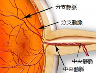 希瑪林順潮眼科中心_視網膜脫落_視網膜靜脈阻塞