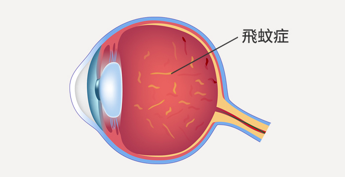 希瑪林順潮眼科中心_飛蚊症